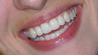 Photo of Restore Your Bright Beautiful Smile With Porcelain Veneers