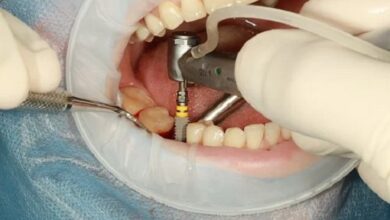 Photo of Advantages of Dental Implants