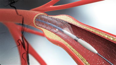 Photo of Why You Should Undergo Carotid Stenting