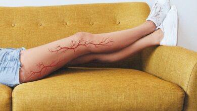 Photo of Want to Get Rid of Spider Veins? Here’s How