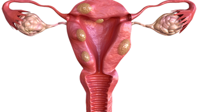 Photo of What Are Fibroids? Are They a Cause for Concern?